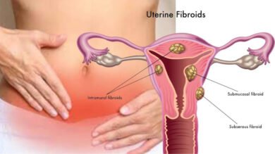Los miomas uterinos