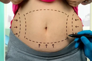 abdominoplastia