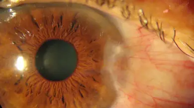 Enfermedades Oculares Comunes: Prevención y Tratamiento